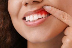 Understanding and Preventing Gum Disease: A Comprehensive Guide