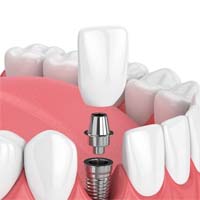 Dental Implants - Overland Park - Kansas City