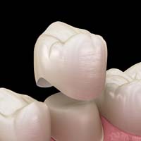 Tooth Crown - Overland Park - Kansas City